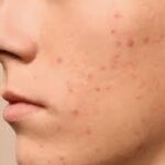 When Acne Treatments Trigger Unexpected Health Problems: A Deep Look into Hidden Side Effects