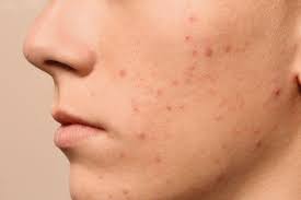 When Acne Treatments Trigger Unexpected Health Problems: A Deep Look into Hidden Side Effects