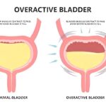 Explore overactive bladder symptoms, causes, and effective treatment options, with clear guidance on management, and when to seek medical advice.
