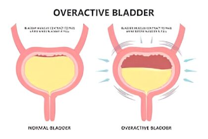Explore overactive bladder symptoms, causes, and effective treatment options, with clear guidance on management, and when to seek medical advice.
