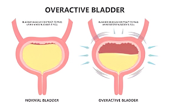 Explore overactive bladder symptoms, causes, and effective treatment options, with clear guidance on management, and when to seek medical advice.
